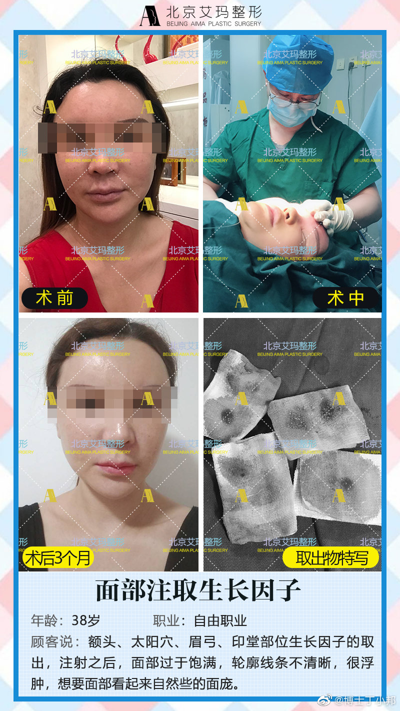 丁小邦和王绍国哪个取异物生长因子好？