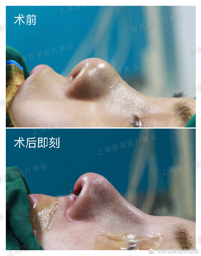 上海鼻修复知名专家都有哪些？大概费用多少？
