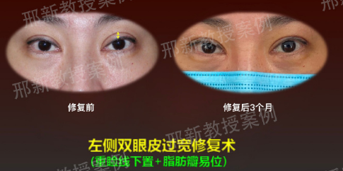 上海有名的双眼皮修复专家有哪些