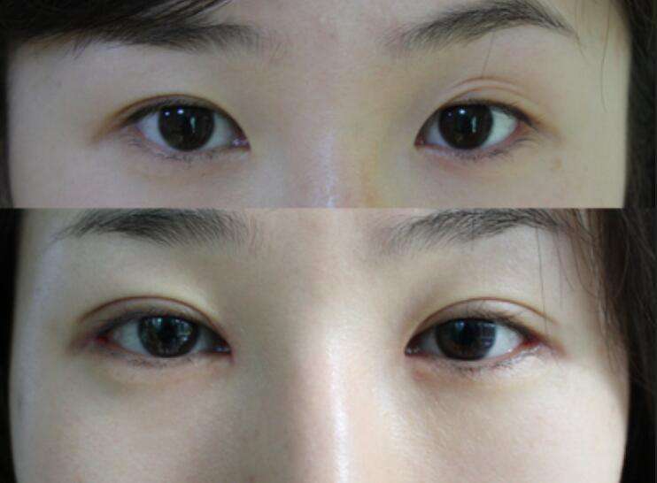 上海九院割双眼皮最好的专家是谁？