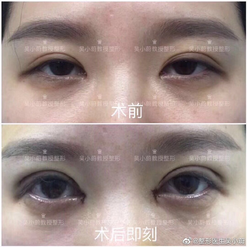 武汉吴小蔚医生做双眼皮修复技术怎么样？