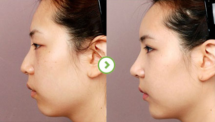 亚洲鼻王郑东学隆鼻技术真的非常厉害吗？