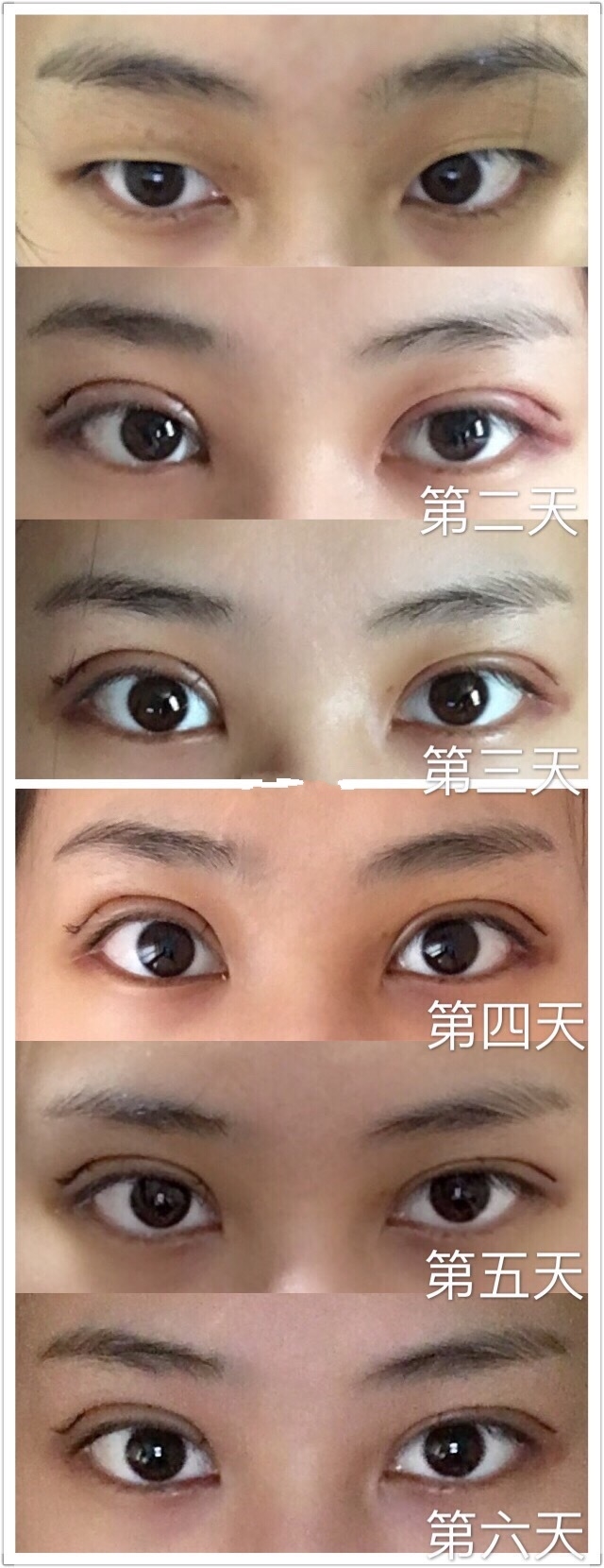 上海九院双眼皮哪个医生比较好？