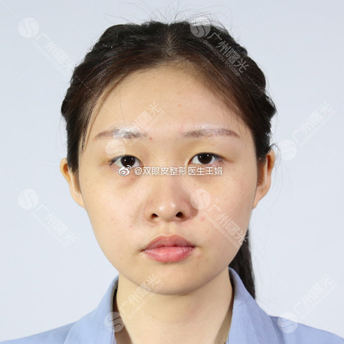 广州曙光王娟双眼皮做的自然吗？技术怎么样？