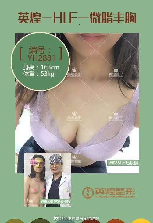 北京自体脂肪丰胸专家哪个最厉害？梁耀婵和刘成胜哪个好？