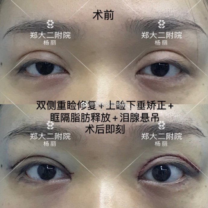 郑州修复双眼皮最好的医生是哪个