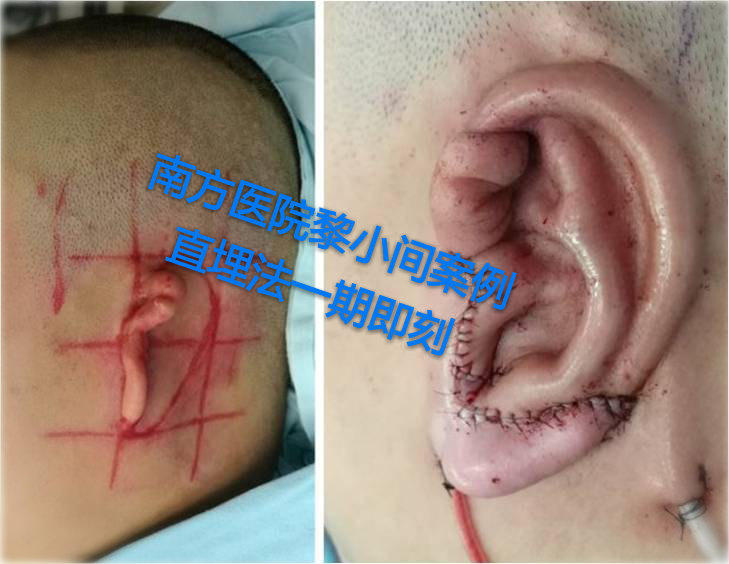 广州南方医院黎小间医生耳再造技术到底好不好？
