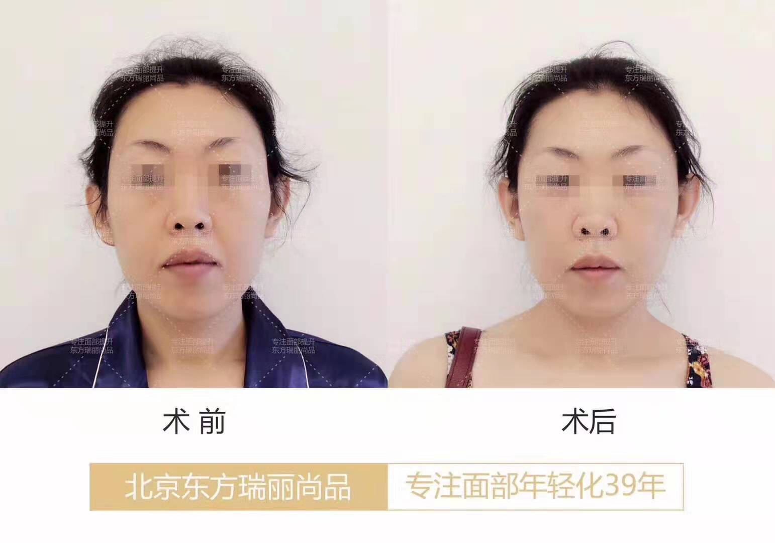 北京李晓东和杨大平谁做面部提升技术好？