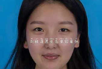 北京邦定刘桂莲割双眼皮技术怎么样