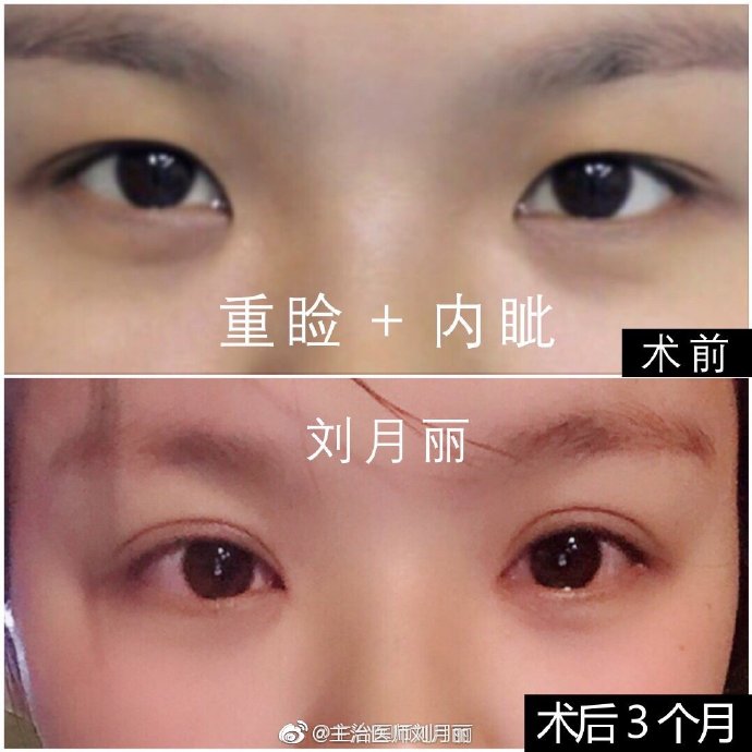 郑州刘月丽和杨丽谁割双眼皮更好些？