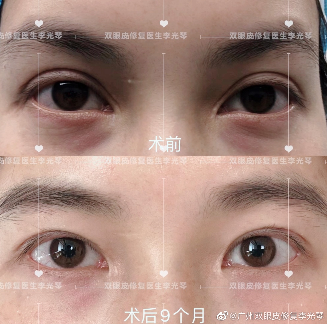 冀晨阳与李光琴修复双眼皮哪个好点？