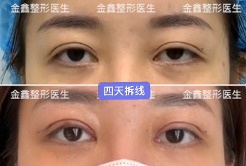 深圳有哪些做双眼皮修复的医生