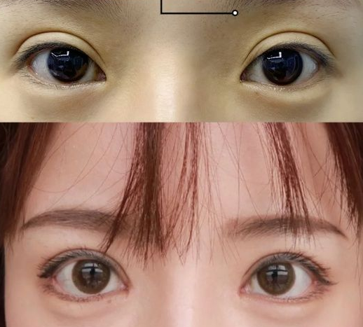 北京双眼皮修复哪个医生比较权威