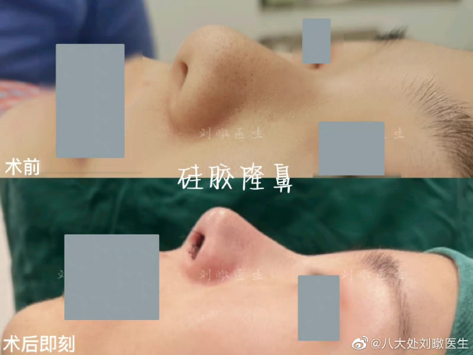 北京八大处隆鼻医生刘暾做鼻子好吗？