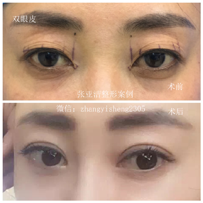 北京张亚洁医生做双眼皮技术好不好？