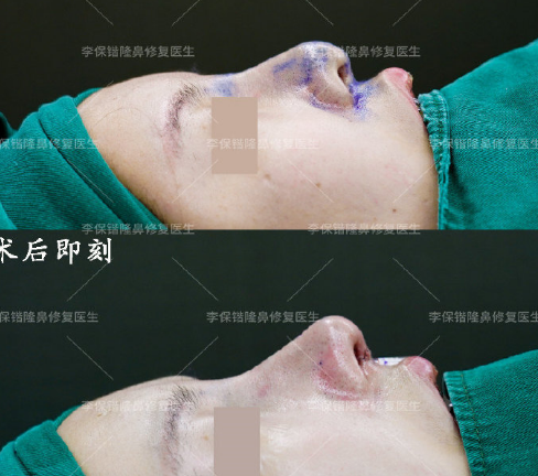 2022年杭州隆鼻修复预约最多的医生是哪个？