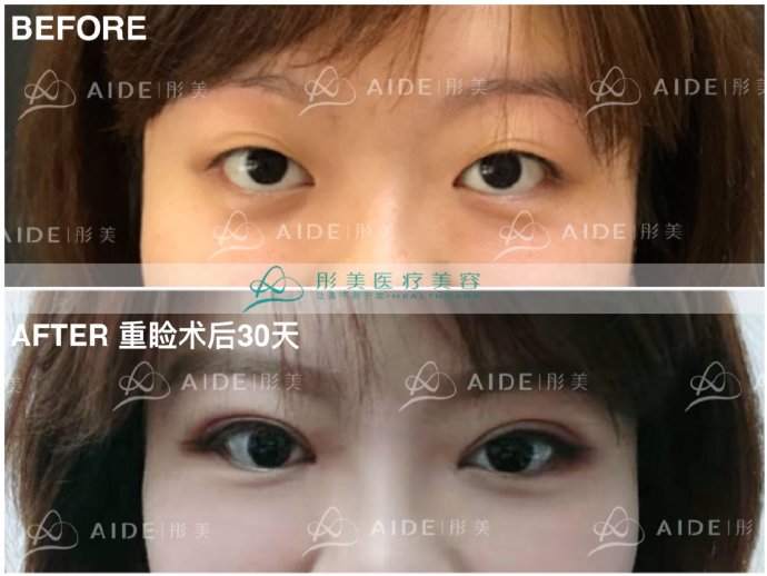 北京著名的双眼皮医生有哪些？