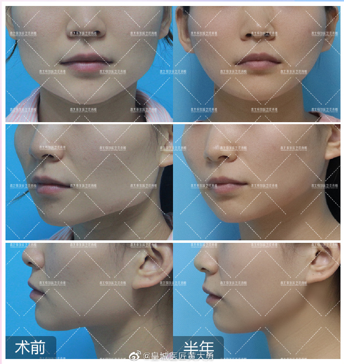 北京哪位医生做下颌角最好？收费贵不贵？