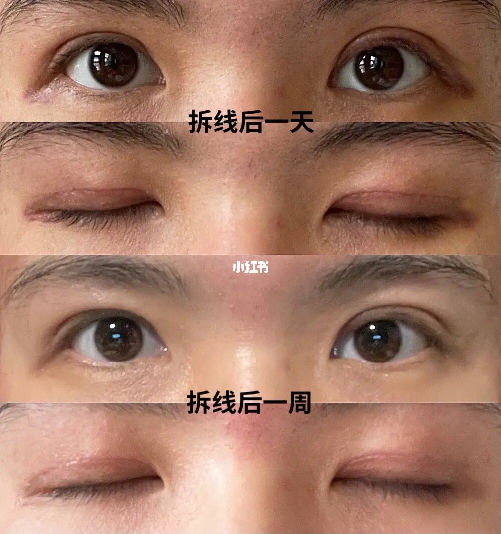 北京八大处哪个医生双眼皮手术预约最多？