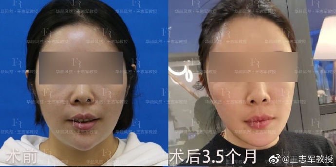 西安王志军做面部提升年轻化口碑好吗？