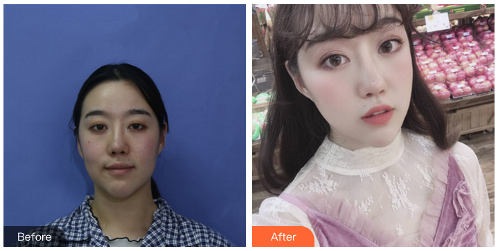 昆明面部脂肪填充哪个医生好