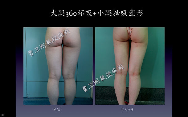 上海九院曹卫刚大腿抽脂效果怎么样？价格贵不贵？