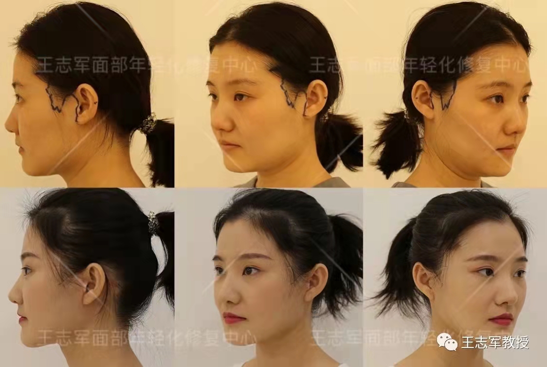 西安王志军面部提升拉皮技术最好吗，留疤吗？