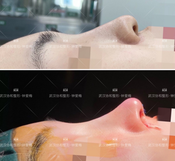武汉鼻子修复最好的医生是谁