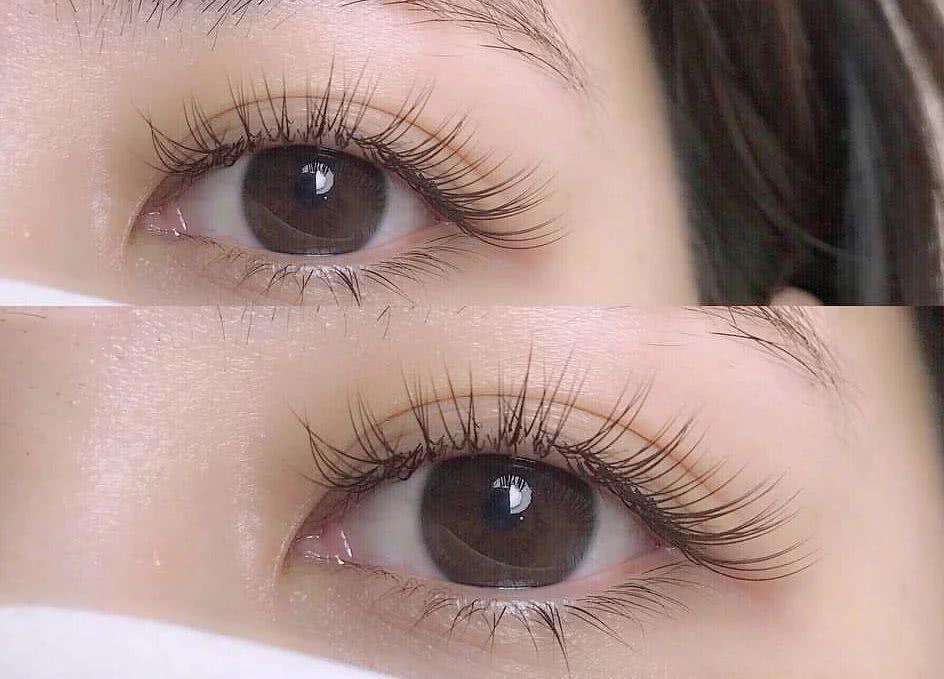 长沙最有权威割双眼皮的医生