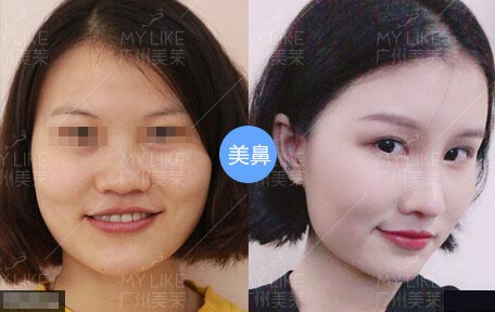 罗延平肋骨做鼻子好吗？鼻综合效果好不好？