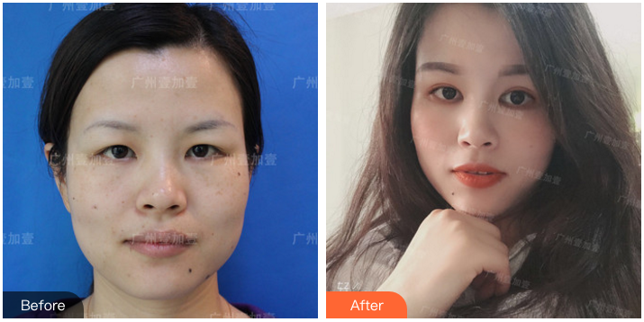 广州双眼皮哪个医生比较好