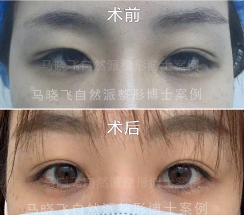马晓飞修复双眼皮怎么样