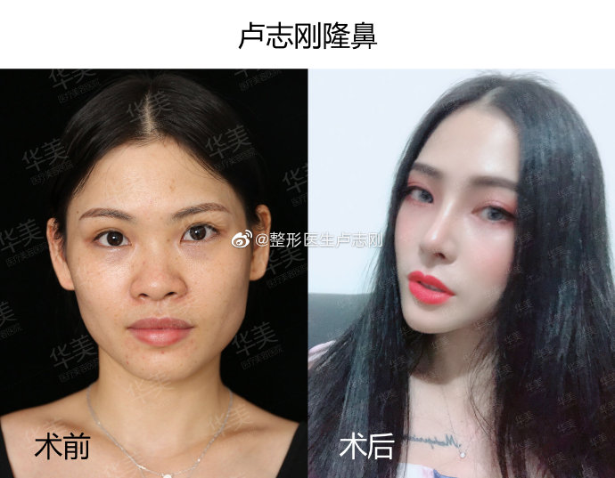 南宁整形鼻子哪个医生最好