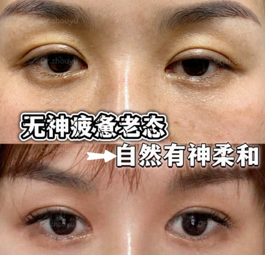 合肥眼修复医生周瑜修复双眼皮技术怎么样？