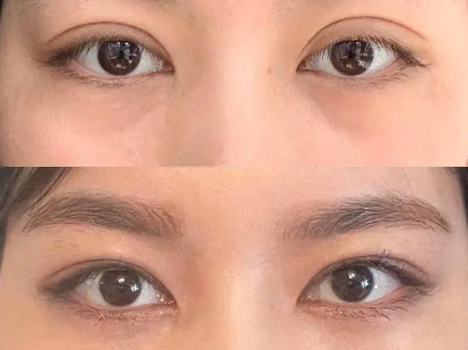 上海九院孙宝珊修复双眼皮怎么样？孙宝珊眼修复技术好吗？