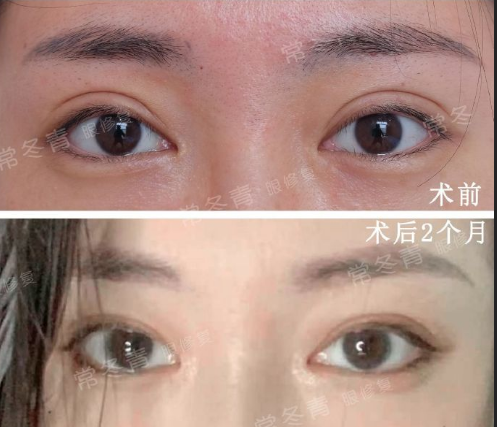 北京常冬青双眼皮修复技术简介案例预约