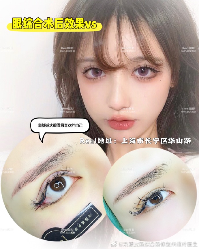 上海朱维玲双眼皮做得好吗