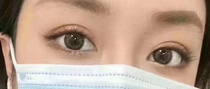 福州双眼皮整形厉害的医生