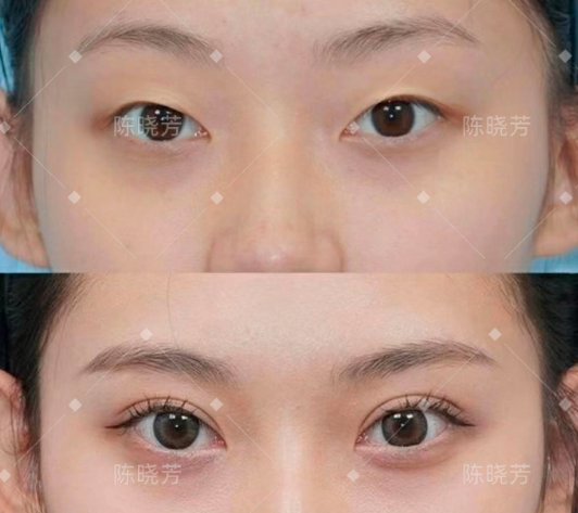 北京朝阳医院陈晓芳做双眼皮怎么样？陈晓芳双眼皮在线预约