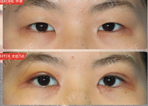 南京刘育凤做双眼皮怎么样？刘育凤双眼皮技术好吗？
