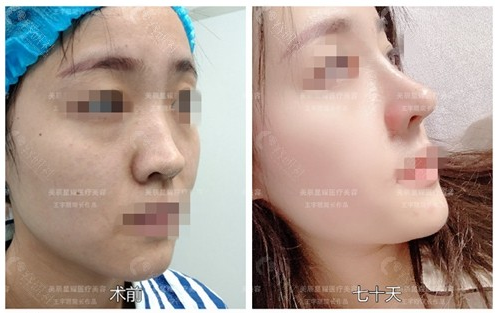 成都王宇琨做鼻子和鼻修复技术怎么样？