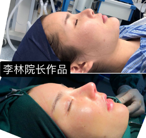 上海李林鼻子做的怎样