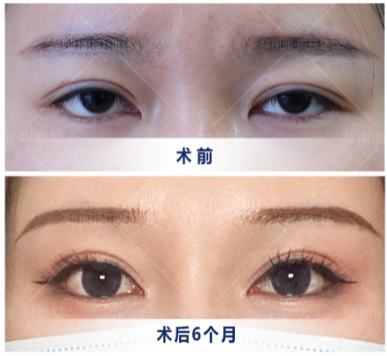 北京双眼皮修复师丽丽怎么样？师丽丽眼修复在线预约咨询电话