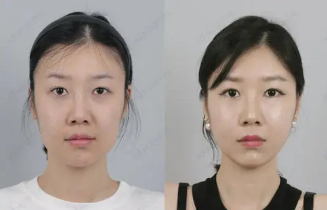 上海九院丁伟做小切口提升反馈怎么样？