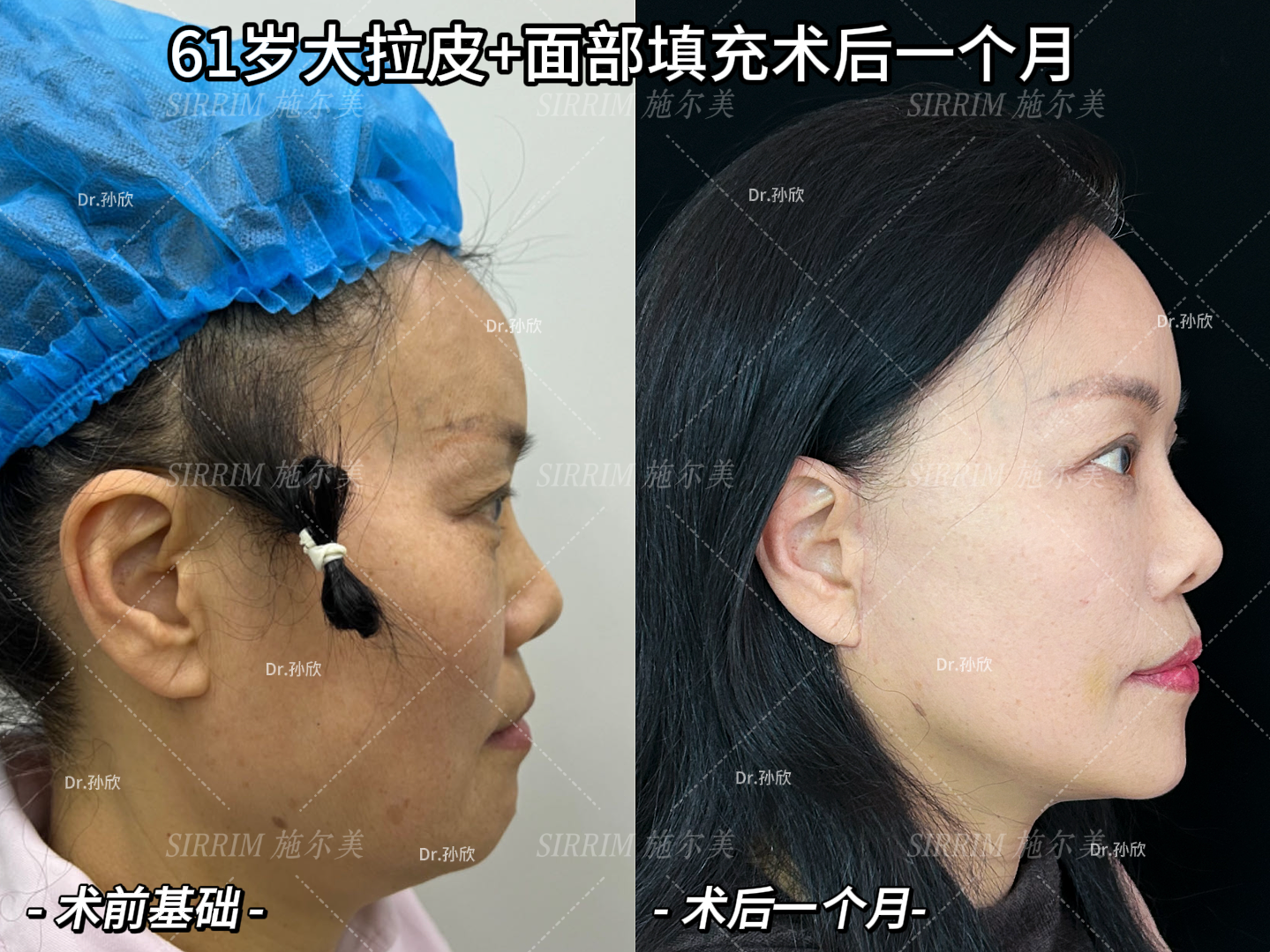 江苏施尔美孙欣做拉皮技术怎么样，孙欣面部提升靠谱不靠谱？