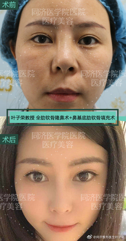 武汉叶子荣和曾宁哪个做鼻子好一点