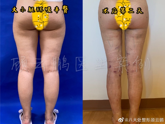 北京八大处最好的吸脂医生
