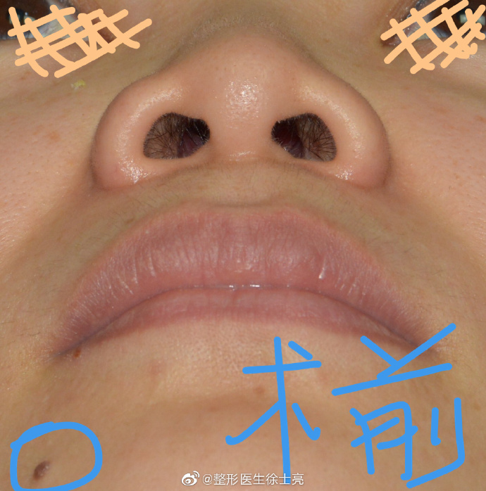 广州徐士亮隆鼻技术好不好？性价比高吗？