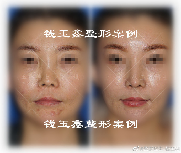上海钱玉鑫做肋骨鼻怎么样