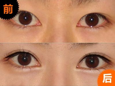 厦门哪个公立医院的医生做双眼皮比较好